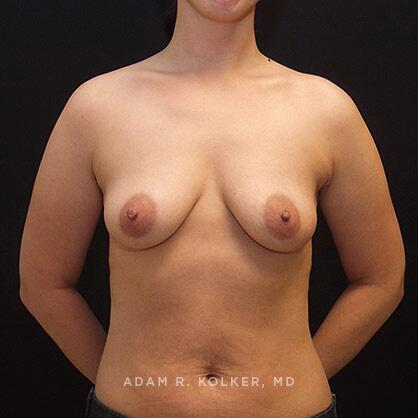 Breast Lift Before Image Patient 14 Front View