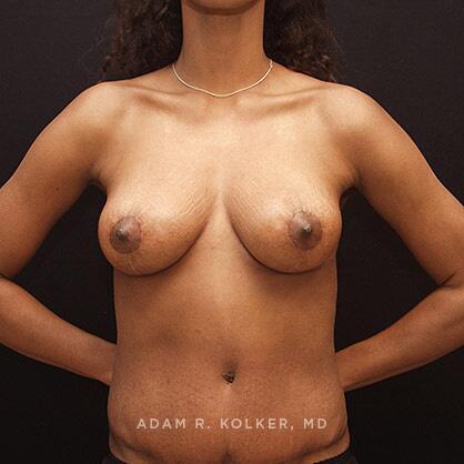Breast Lift After Image Patient 19 Front View