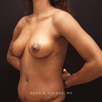 Breast Lift After Image Patient 19 Oblique View