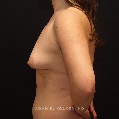 Breast Lift Before Image Patient 20 Side View