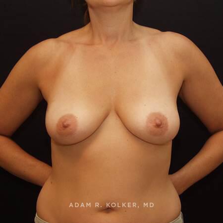 Breast Reconstruction Before Image Patient 01 Front View