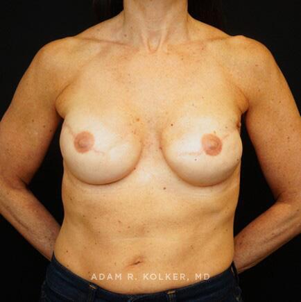 Breast Reconstruction After Image Patient 02 Front View