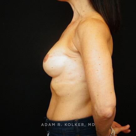 Breast Reconstruction After Image Patient 02 Side View