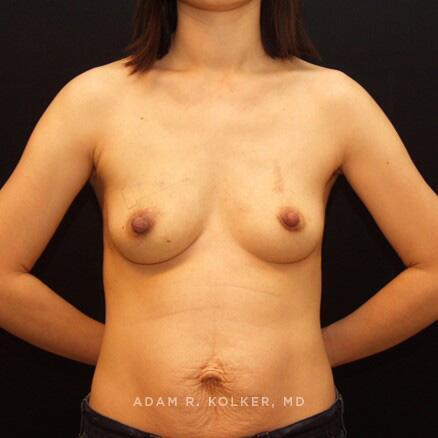 Breast Reconstruction After Image Patient 04 Front View