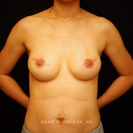 Breast Reconstruction After Image Patient 04 Front View