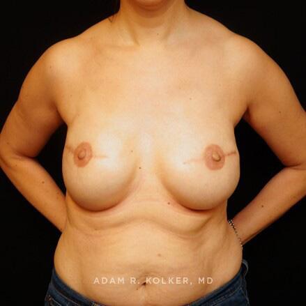Breast Reconstruction After Image Patient 06 Front View