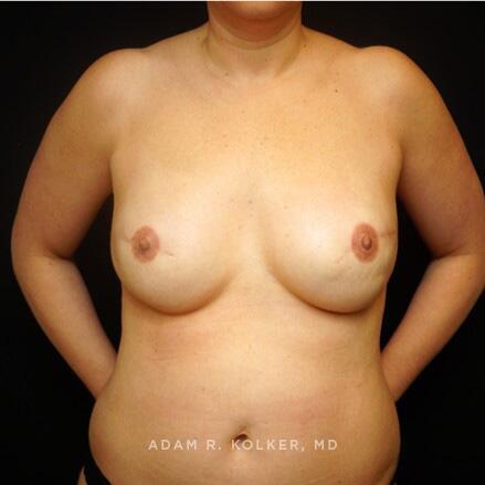 Breast Reconstruction After Image Patient 07 Front View