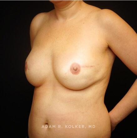 Breast Reconstruction After Image Patient 07 Oblique View