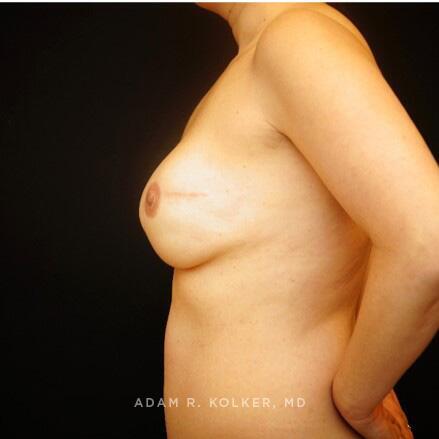 Breast Reconstruction After Image Patient 07 Side View