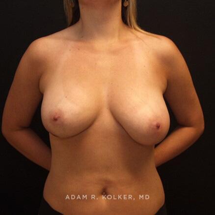 Breast Reconstruction Before Image Patient 08 Front View