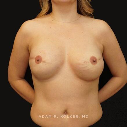 Breast Reconstruction After Image Patient 08 Front View