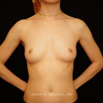Breast Reconstruction Before Image Patient 12 Front View