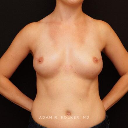 Breast Reconstruction After Image Patient 12 Front View