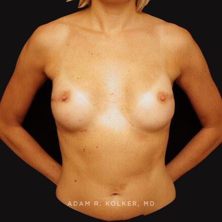 Breast Reconstruction After Image Patient 13 Front View