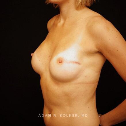 Breast Reconstruction After Image Patient 13 Oblique View