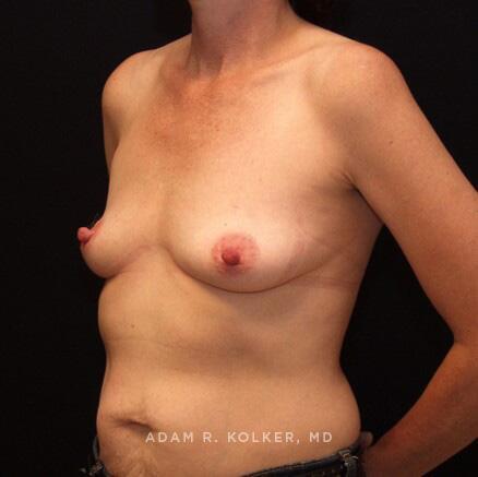 Breast Reconstruction Before Image Patient 14 Oblique View