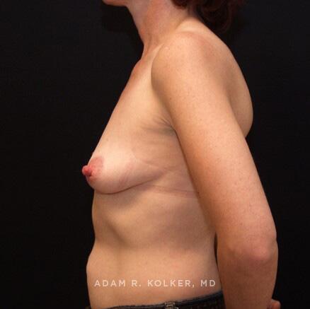 Breast Reconstruction Before Image Patient 14 Side View
