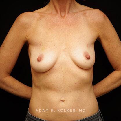 Breast Reconstruction Before Image Patient 17 Front View
