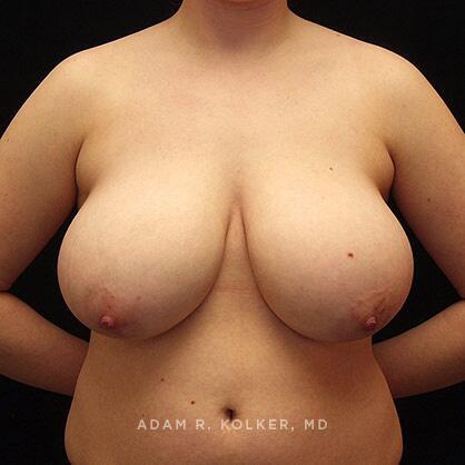 Breast Reduction Before Image Patient 02 Front View