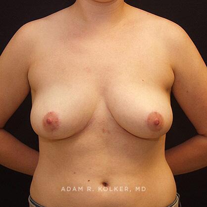 Breast Reduction After Image Patient 02 Front View