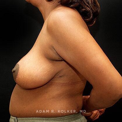 Breast Reduction Before and After Image