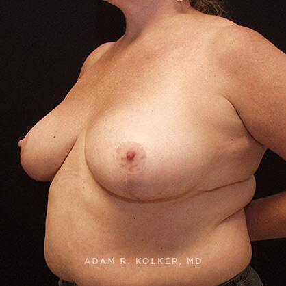 Breast Reduction After Image Patient 04 Oblique View