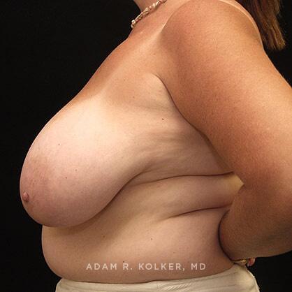 Breast Reduction Before Image Patient 04 Side View