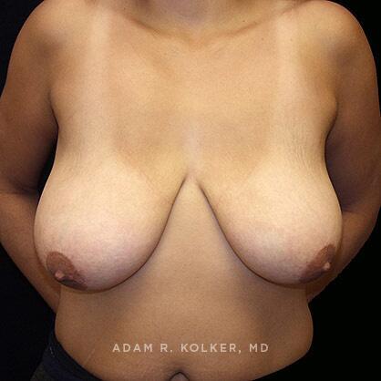 Breast Reduction Before Image Patient 06 Front View