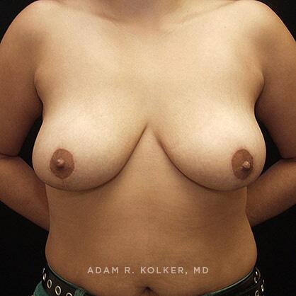 Breast Reduction After Image Patient 06 Front View