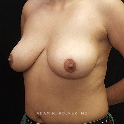 Breast Reduction After Image Patient 06 Oblique View