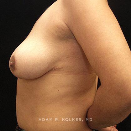 Breast Reduction After Image Patient 06 Side View