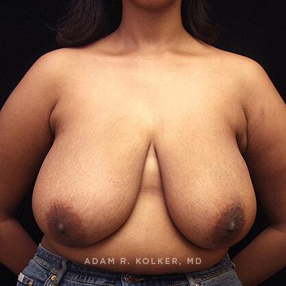 Breast Reduction Before Image Patient 07 Front View
