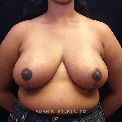 Breast Reduction After Image Patient 07 Front View