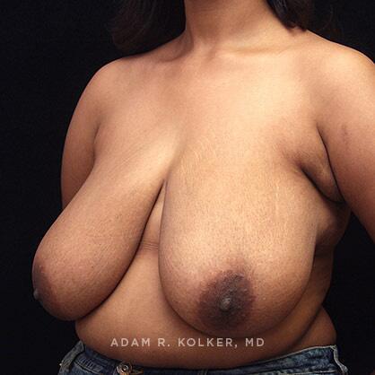 Breast Reduction Before Image Patient 07 Oblique View