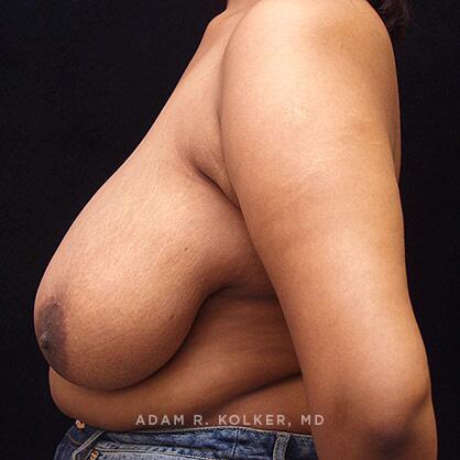 Breast Reduction After Image Patient 07 Side View