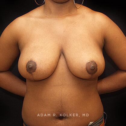 Breast Reduction After Image Patient 08 Front View