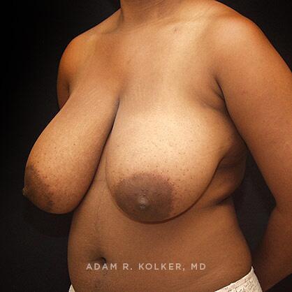 Breast Reduction Before Image Patient 08 Oblique View