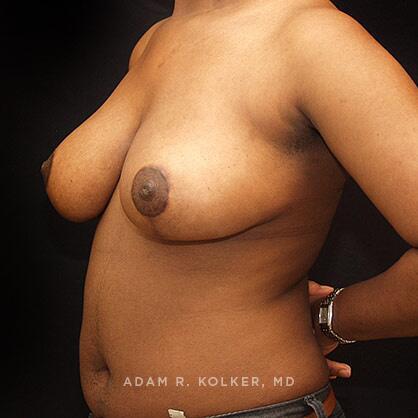 Breast Reduction After Image Patient 08 Oblique View