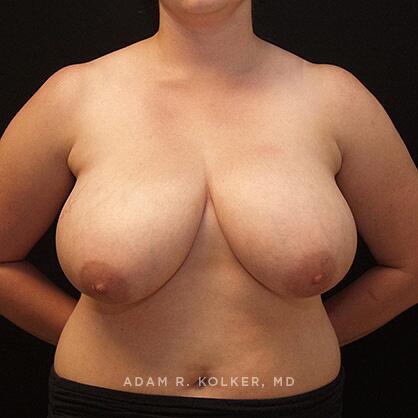 Breast Reduction Before Image Patient 14 Front View