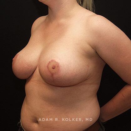 Breast Reduction After Image Patient 14 Oblique View