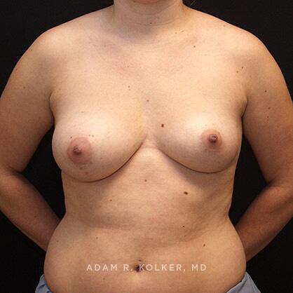 Breast Reduction Before Image Patient 16 Front View