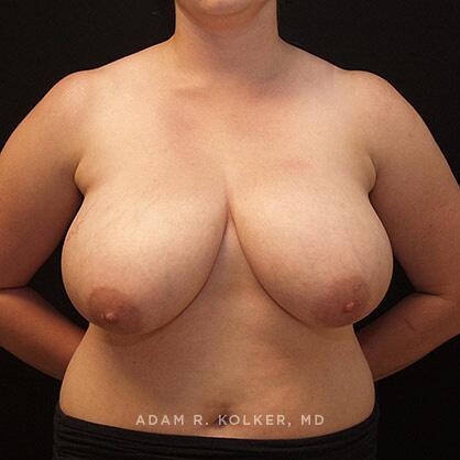 Breast Reduction Before Image Patient 17 Front View