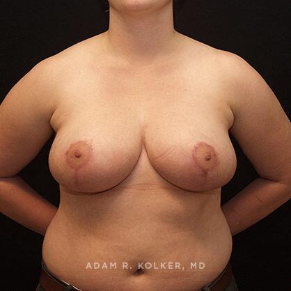 Breast Reduction After Image Patient 17 Front View