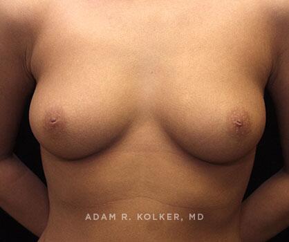 Inverted Nipple Correction After Image Patient 03 Front View