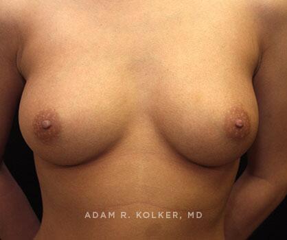 Inverted Nipple Correction After Image Patient 03 Front View