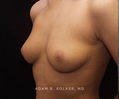 Inverted Nipple Correction Before Image Patient 03 Oblique View