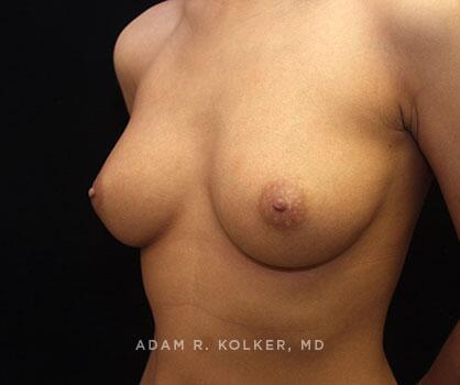 Inverted Nipple Correction After Image Patient 03 Oblique View