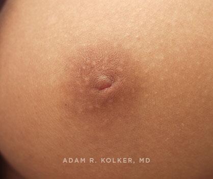 Inverted Nipple Correction Before Image Patient 03 Side View