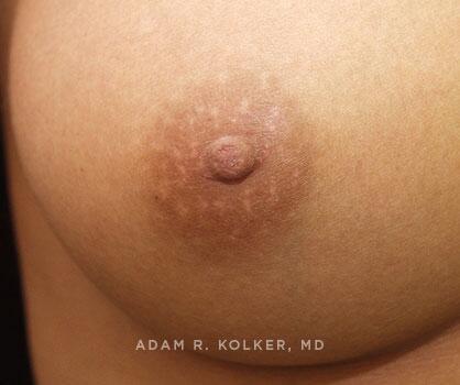 Inverted Nipple Correction After Image Patient 03 Side View