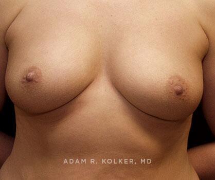 Inverted Nipple Correction After Image Patient 05 Front View